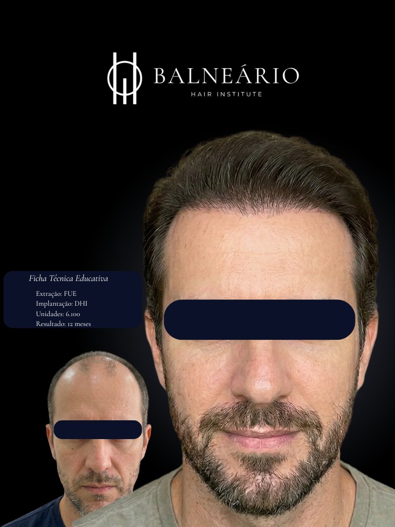 Resultado transplante capilar FUE Sapphire — Caso 1 — Balneário Hair Institute