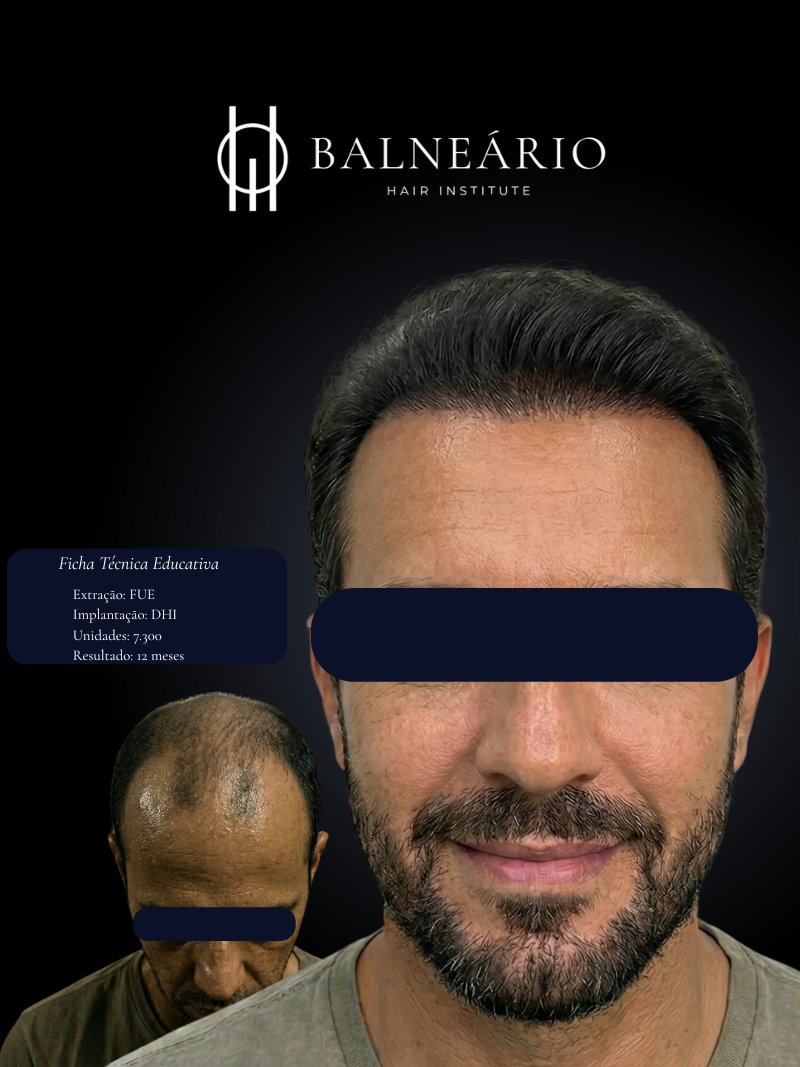 Resultado transplante capilar DHI Choi — Caso 2 — Balneário Hair Institute