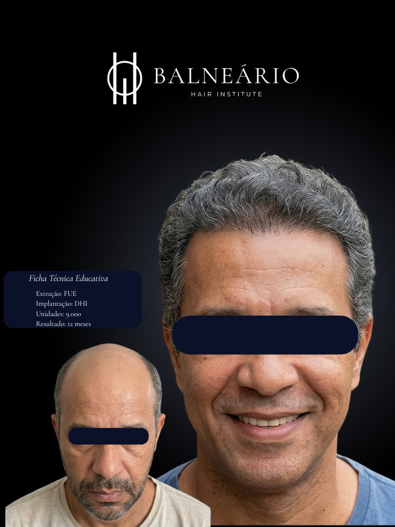 Resultado transplante capilar FUE — Caso 3 — Balneário Hair Institute