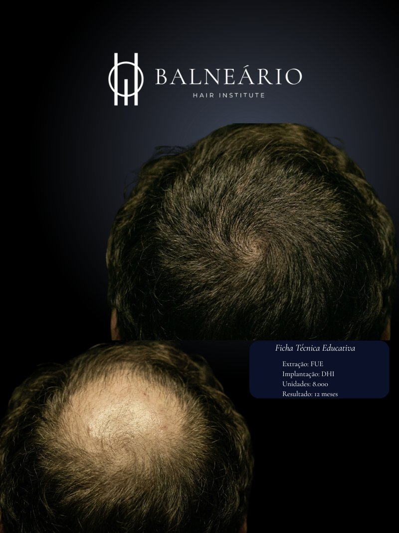 Resultado transplante capilar DHI — Caso 5 — Balneário Hair Institute